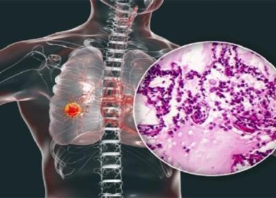 سرطان ریه شایع ترین و کشنده ترین تومور در بدن انسان